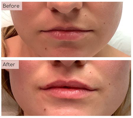 lip fillers before and afters